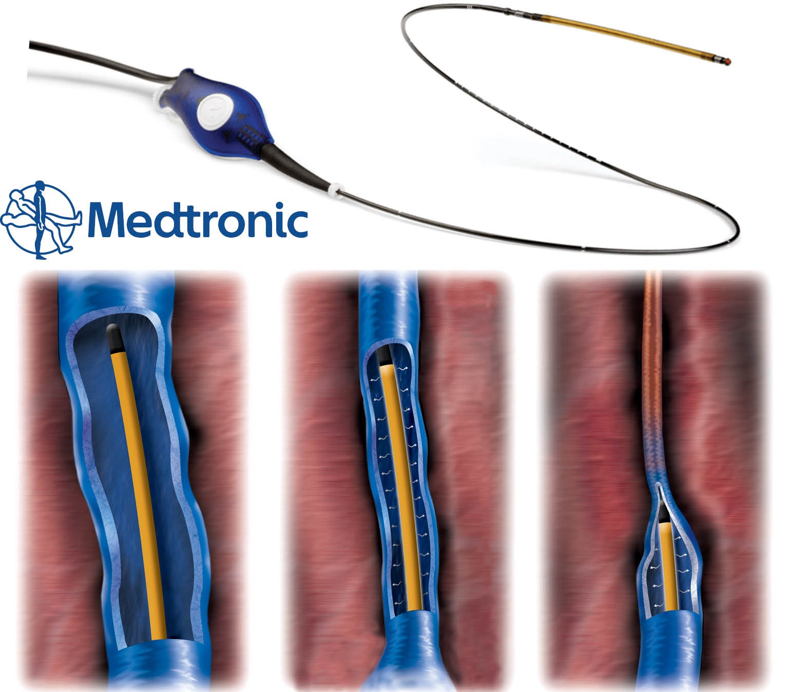 Ռադիոալիքային աբլացիա. Նորագույն մոտեցում վարիկոզի բուժման հարցում
