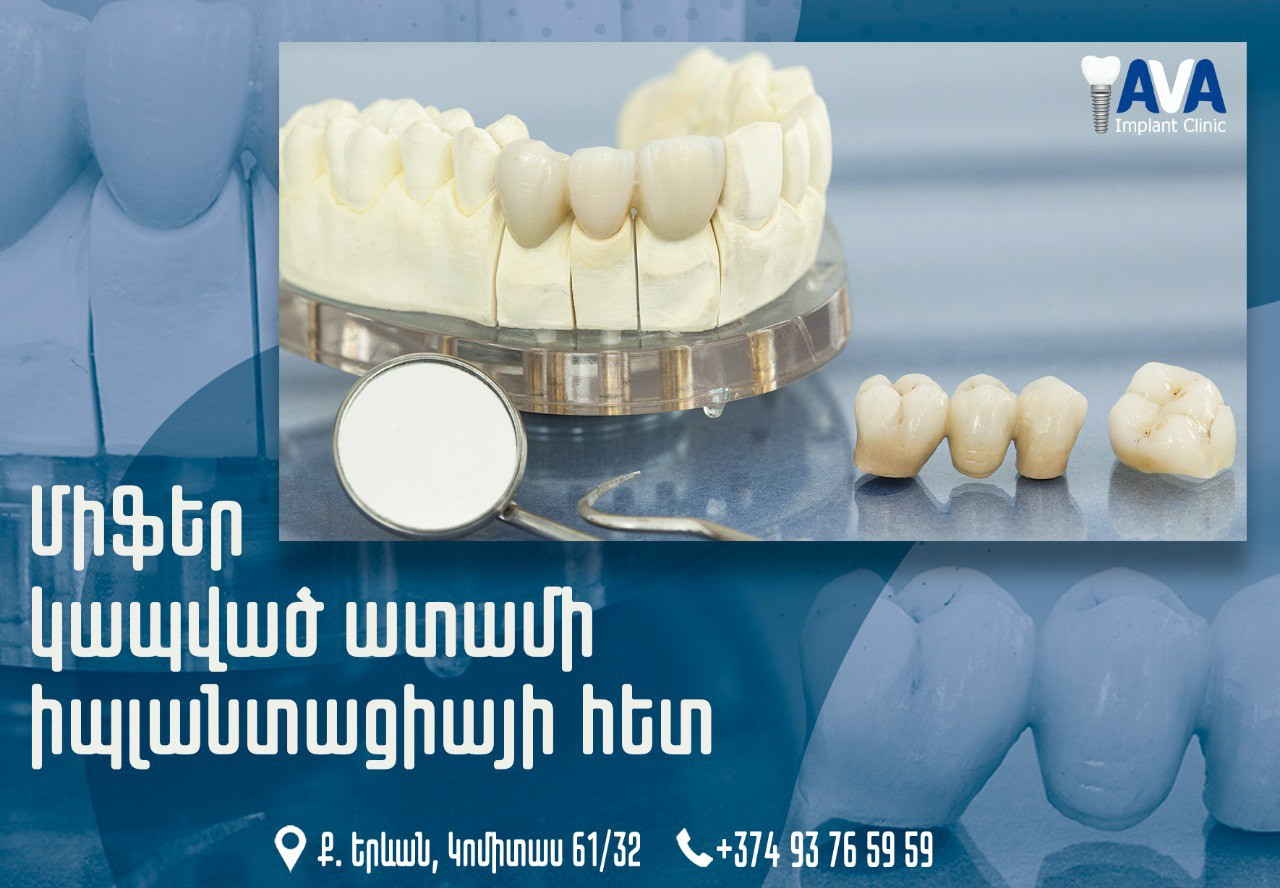 ՄԻՖԵՐ՝ ԿԱՊՎԱԾ ԱՏԱՄԻ ԻՄՊԼԱՆՏԱՑԻԱՅԻ ՀԵՏ